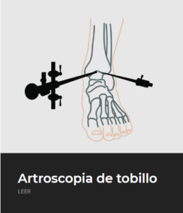 Artroscopia de tobillo - ECiPP 