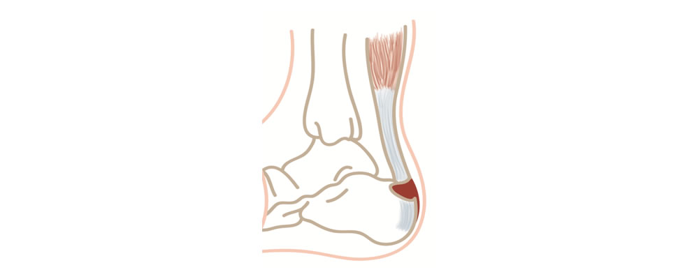 Tendinopatia - ECiPP